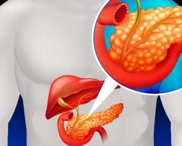 Pancreatite Crônica: causas, sintomas e tratamento