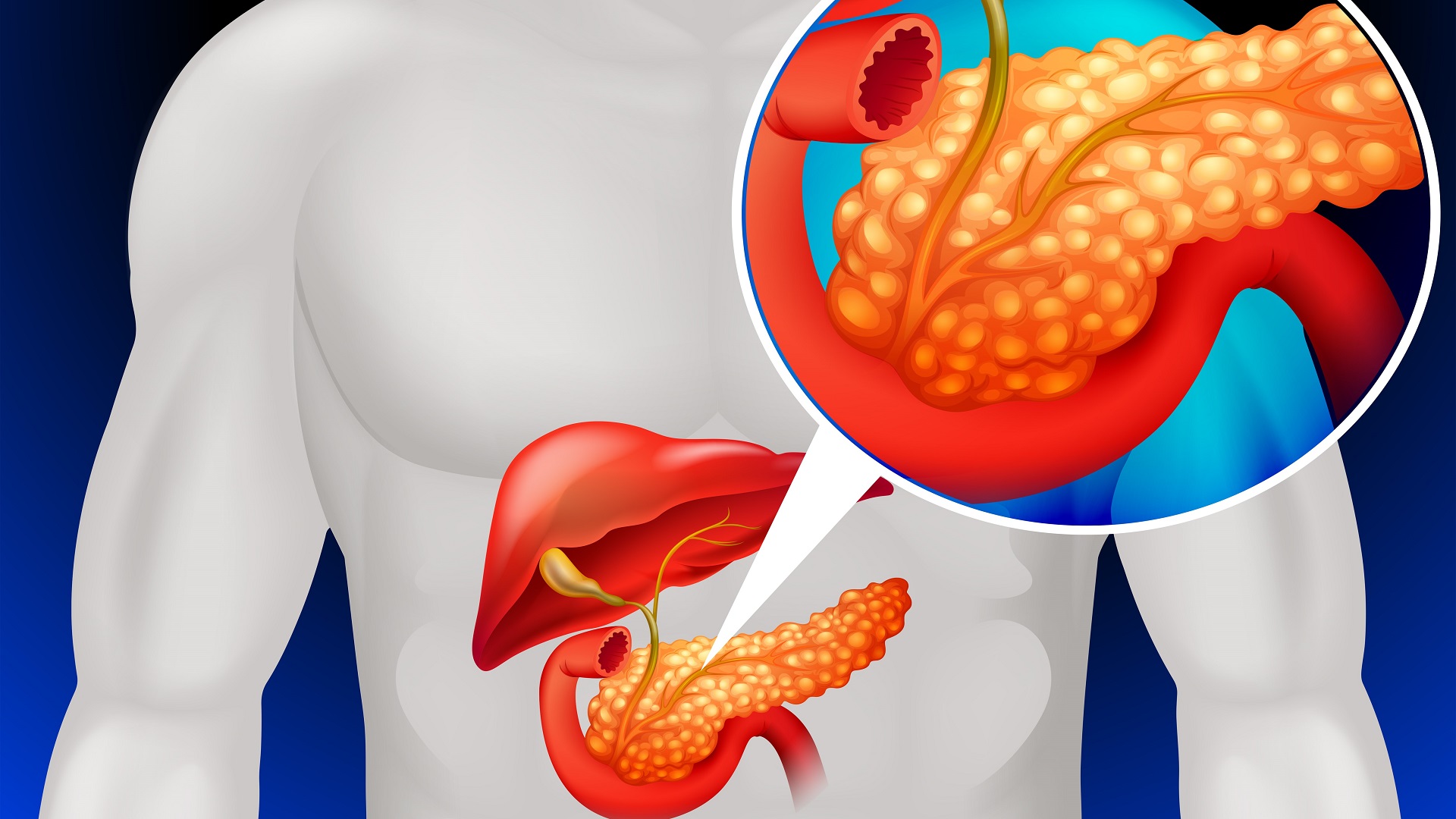 Pancreatite Crônica: causas, sintomas e tratamento