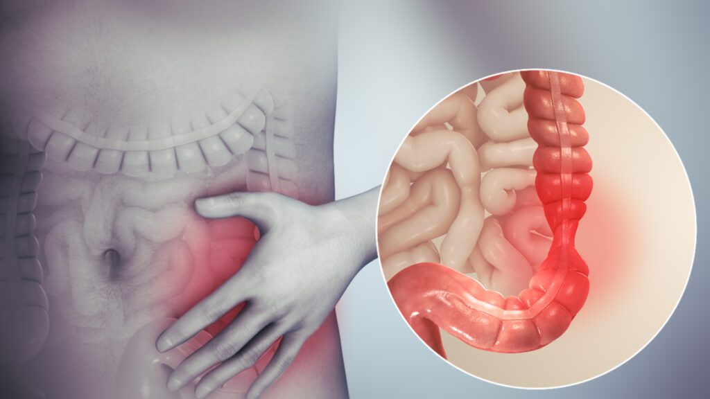 Síndrome do Intestino Irritável (SII): sintomas, causas e tratamento